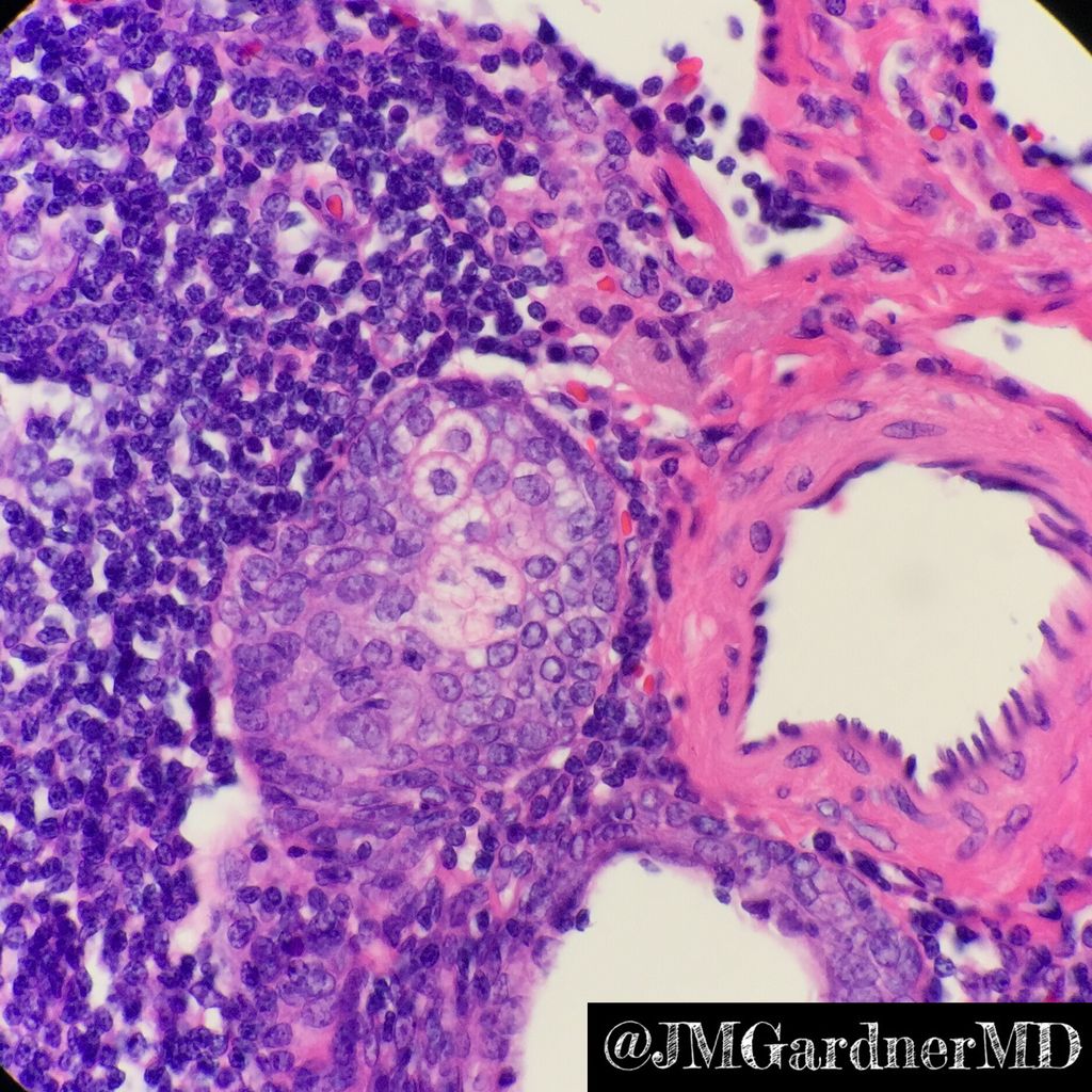 JMGardnerMD's tweet photo. Sebaceous lymphadenoma. Rare benign salivary tumor. Keratin cysts, nests of sebocytes, lymphoid background. #ASCP40underForty2017 #pathology https://t.co/x09iOPHjuc