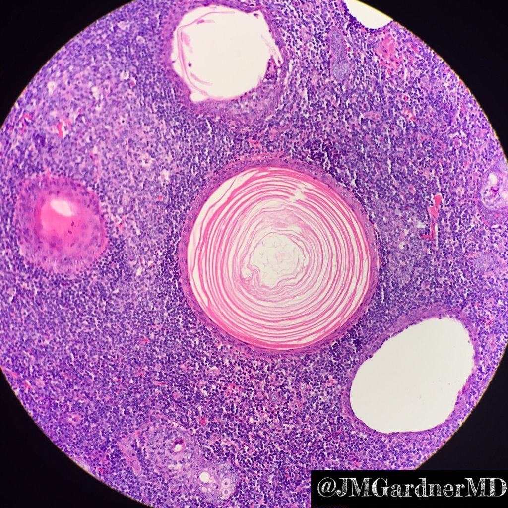 JMGardnerMD's tweet photo. Sebaceous lymphadenoma. Rare benign salivary tumor. Keratin cysts, nests of sebocytes, lymphoid background. #ASCP40underForty2017 #pathology https://t.co/x09iOPHjuc