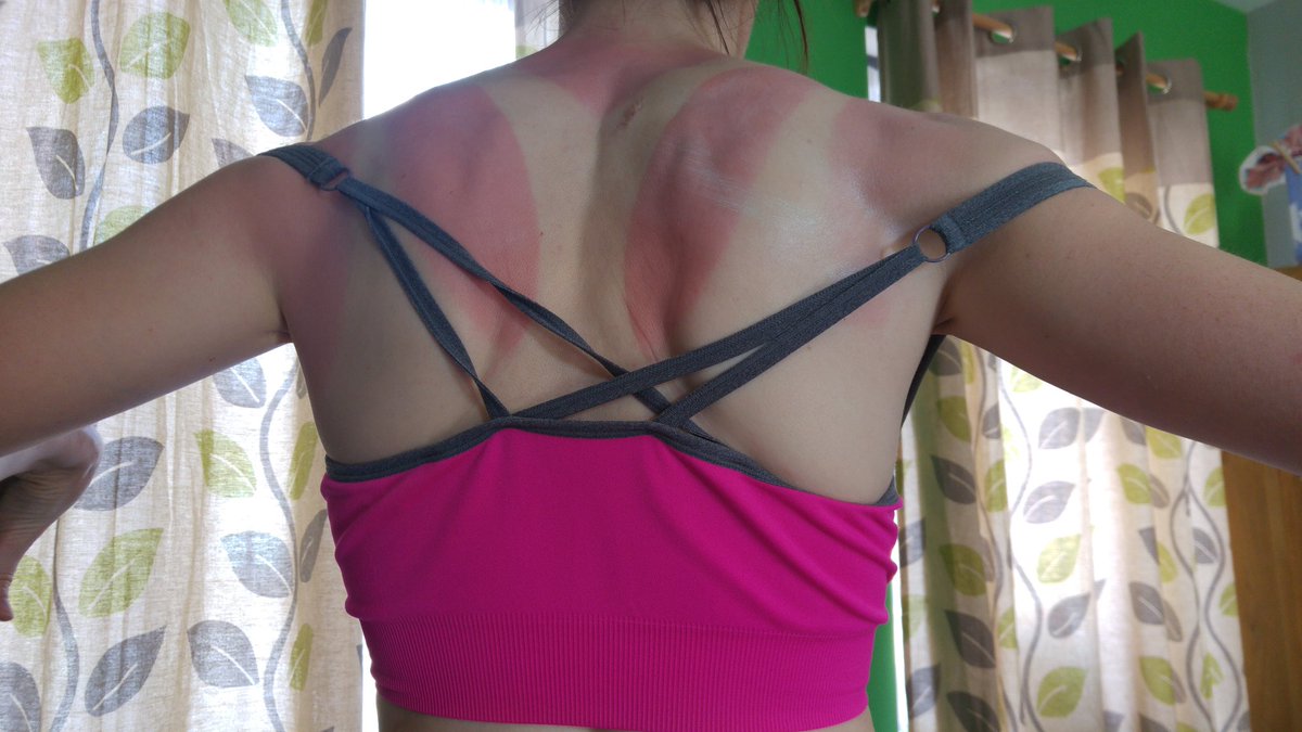 DorindaDorinda's tweet photo. #UseSuncream even if you do want to be in the X-Men. https://t.co/3whMCr2eld