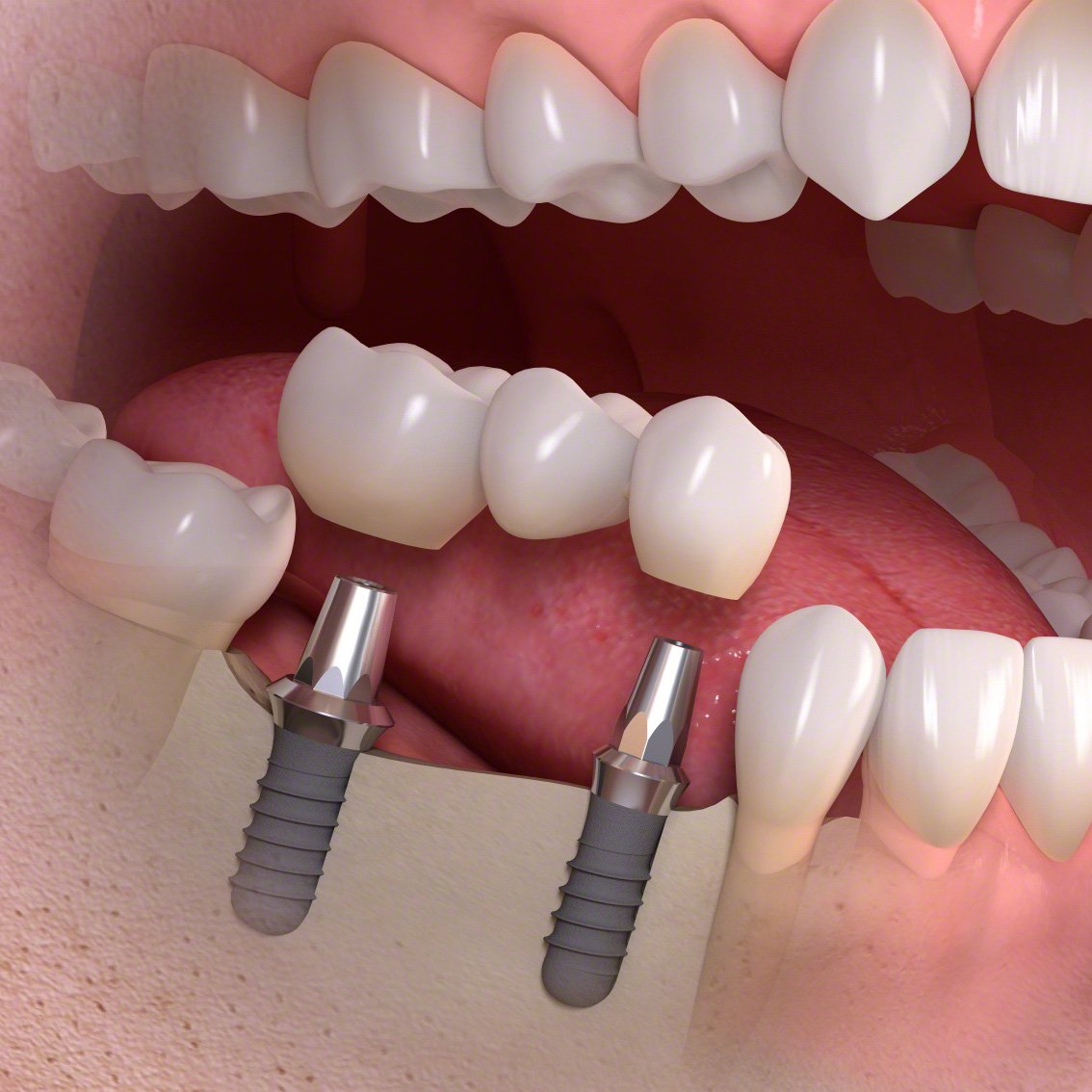 HowardFarran's tweet photo. According to the American Academy of Implant Dentistry, about 3 million people receive 5.5 million implants each year in the United States. https://t.co/lH7QWej8NK