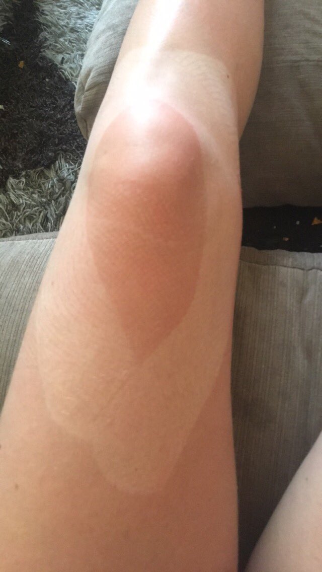 Sunburn