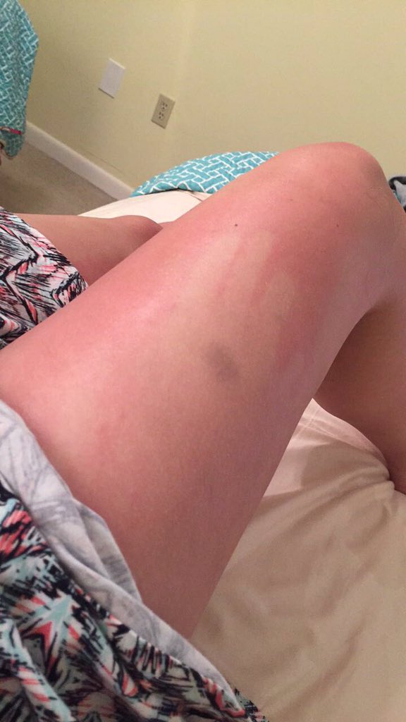 Sunburn
