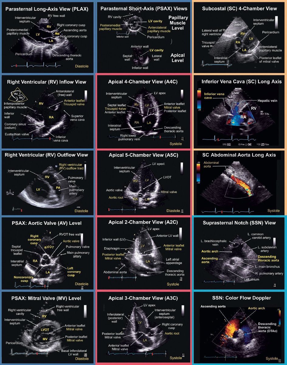 Best 'Echograph' I've seen in a while! #FOAMed #FOAMcc #POCUS