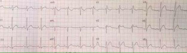 Bruguda sendromu tip 2 EKG.