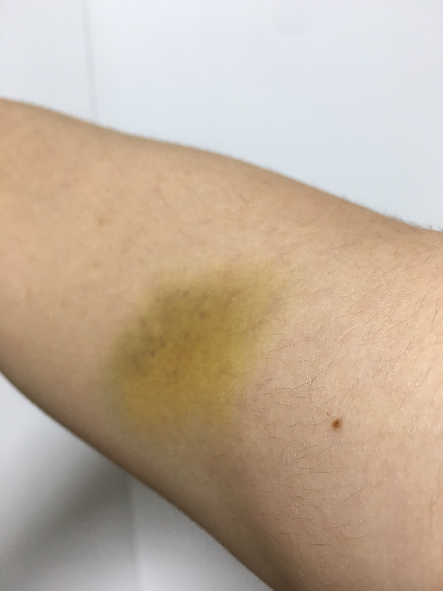 かっぺ ふと見ると右腕に青あざを超えて黄緑あざがあったんですが私は大丈夫なのでしょうか 肌がこの色になるのホーリー以来よ T Co Pbasuu2lh6 Twitter