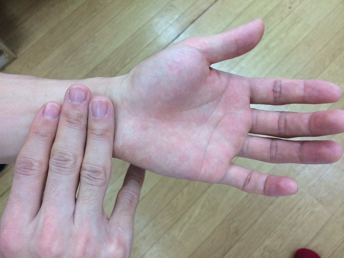 mococo321's tweet photo. 気圧の低下で頭痛、めまい、倦怠感、肩こり、イライラ、喘息、神経痛などツラい！すぐ楽になりたい方は『内関』のツボがオススメ✳︎
内関は手首のシワから指3本分下、2本の筋の間にあります。
少し強めに5秒(ゆっくり押し込む)、5秒(離す)で押しましょう♪
少し強めに7回程押しましょう！ https://t.co/tY7RBdhDMg