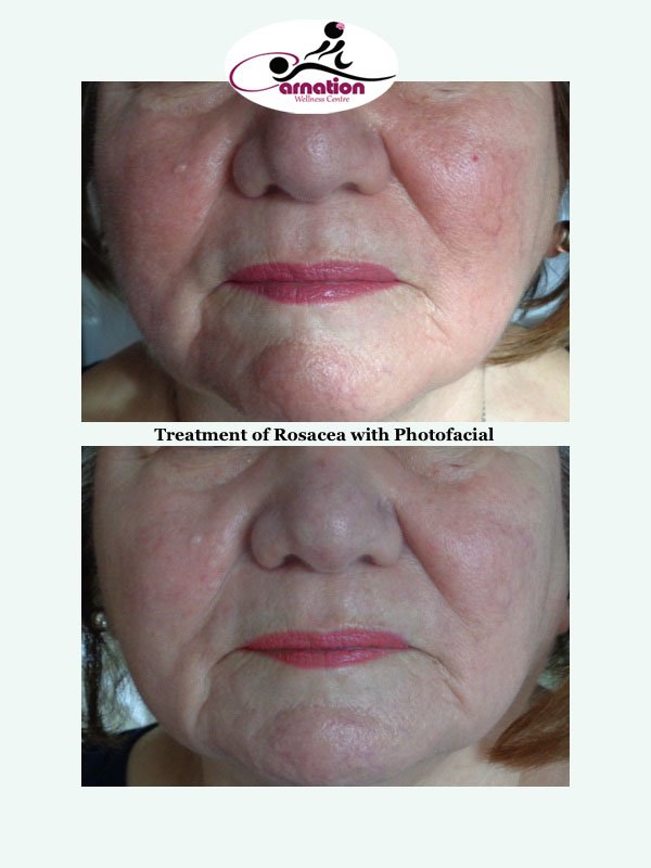 COREceutical's tweet photo. Treatment of #Rosacea by #Photofacial
https://t.co/eatoddUBRL https://t.co/RhaW2hMpRD