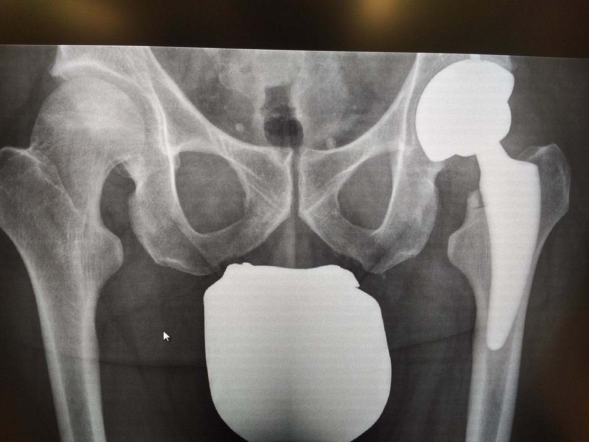 37 y male #patient with #ARCO 3-4 #AVN #hip #THA 
#Hüftkopfnekrose #HüftTEP #TEP