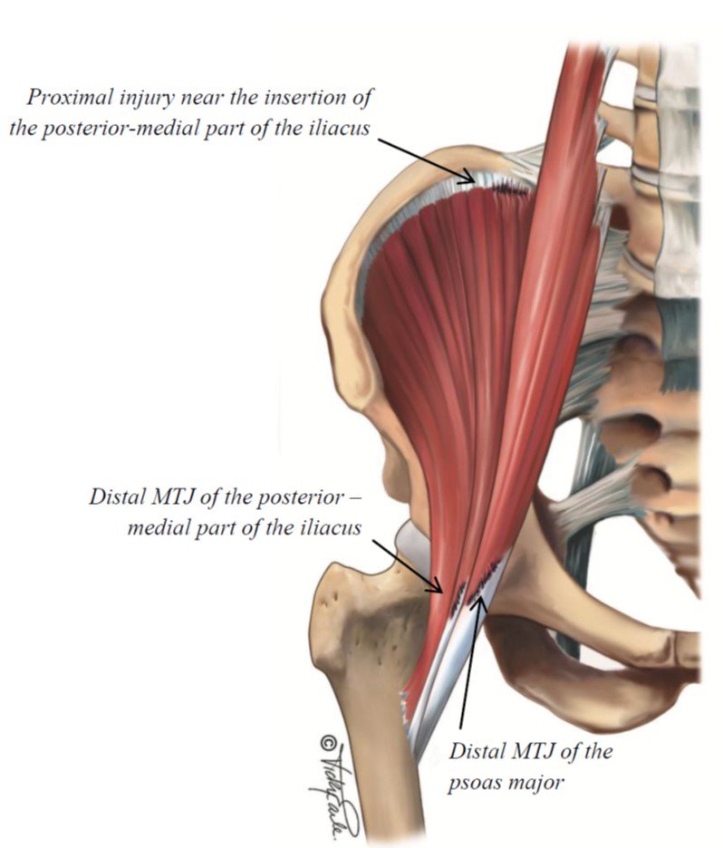 carlespedret's tweet photo. Acute hip flexors and acute adductor muscles injury characteristics. 

https://t.co/FSzTMMZBEM
https://t.co/yiZmFK3TJj

GREAT JOB as always! https://t.co/xfdEneu8Me