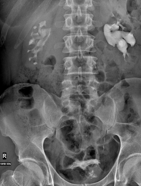 BDybowski's tweet photo. UPJ dx obstruct
2015 scint 25%
2016 ivp: null -> JJ 4mo->7%
Nephrectomy? 
No!!! Wait longer.
Today JJex, ivp and pyeloplasty @ewabres https://t.co/XiDScvDNRH
