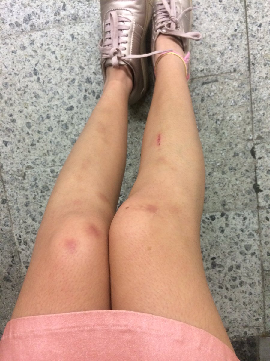 ChiaraPriscila2's tweet photo. Ni yo sé cómo terminó con tantos moretones. 😬🙄 https://t.co/vWYT3rkIfq