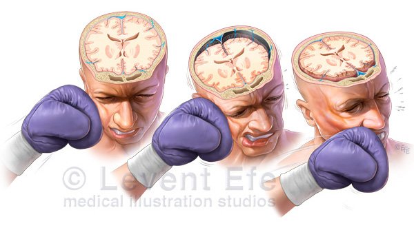 efemedicalarts's tweet photo. Brain slamming forward, then backward. Visual ammunition to put an end to boxing. Art available at https://t.co/kTXMtJfC3e https://t.co/i2GQybj1Bd