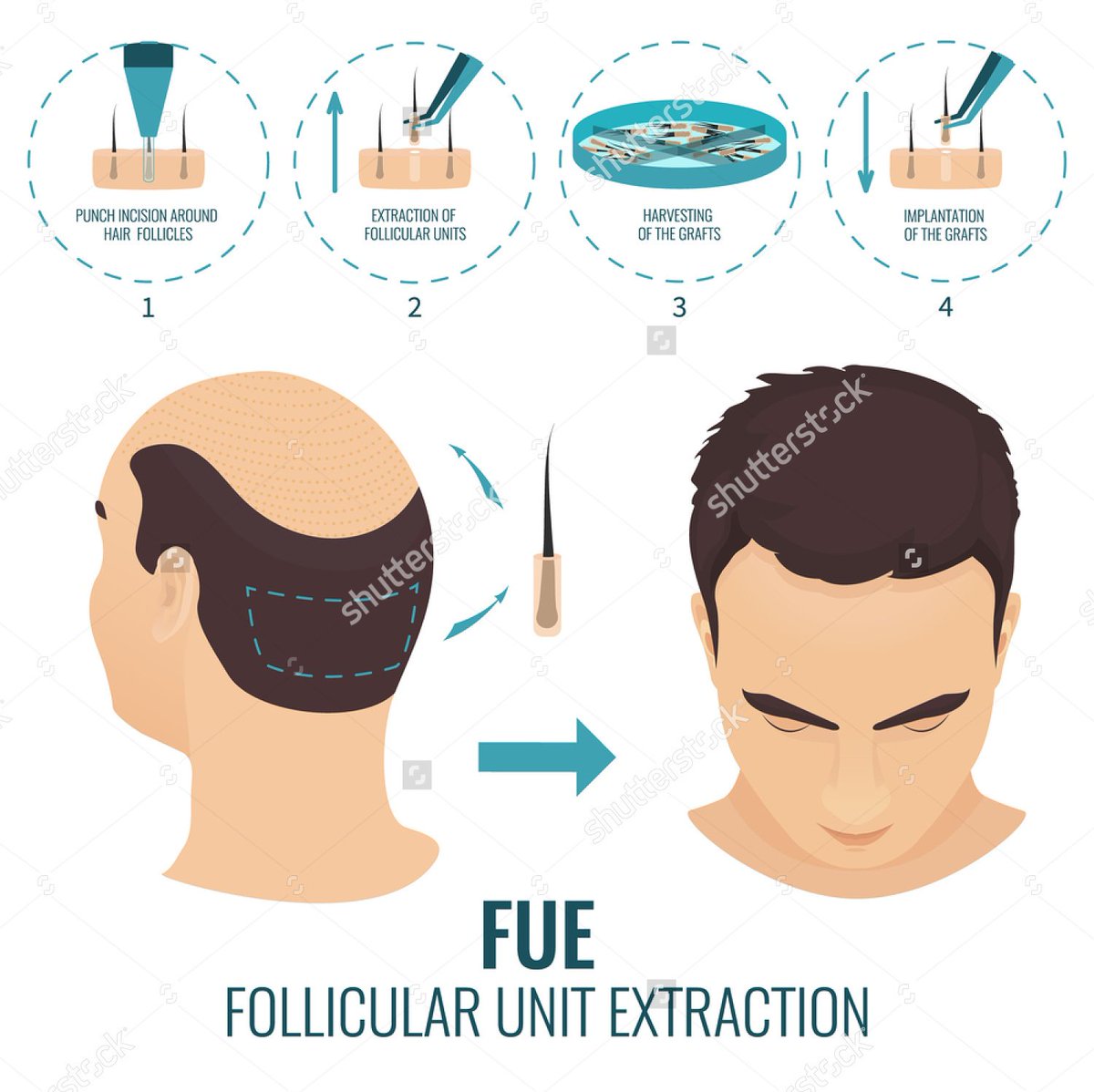 Sahay96Sahay's tweet photo. Facts about #Hair #Transplant Surgery Procedure, Risks and Care
Read Blog Post On #WordPress @transplantworl1 https://t.co/AOYWLpTOdW https://t.co/z1CwaUo8fg