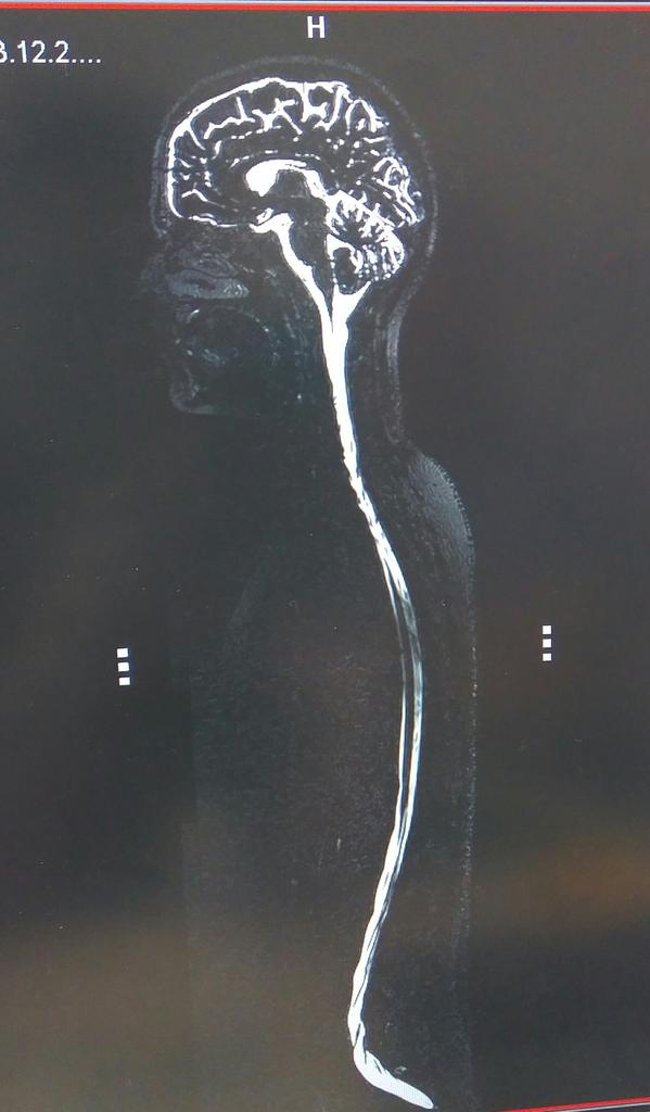 furby10's tweet photo. Trying out a new scan. Check out my CSF ;-)@JessSteventon #MRI #Researchforfun #fridayscience https://t.co/TmYcsymYno