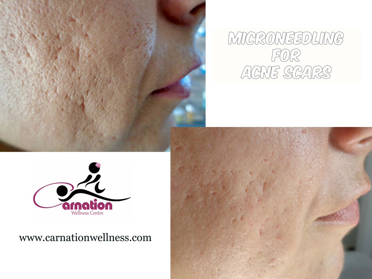 COREceutical's tweet photo. #microneedling #mesotherapy for #acne #scar
https://t.co/ENWIKa7hor
Get Vitalized! You Deserve it, We Care!
#carnationwellness #stretchmarks https://t.co/r2MRykHpQp