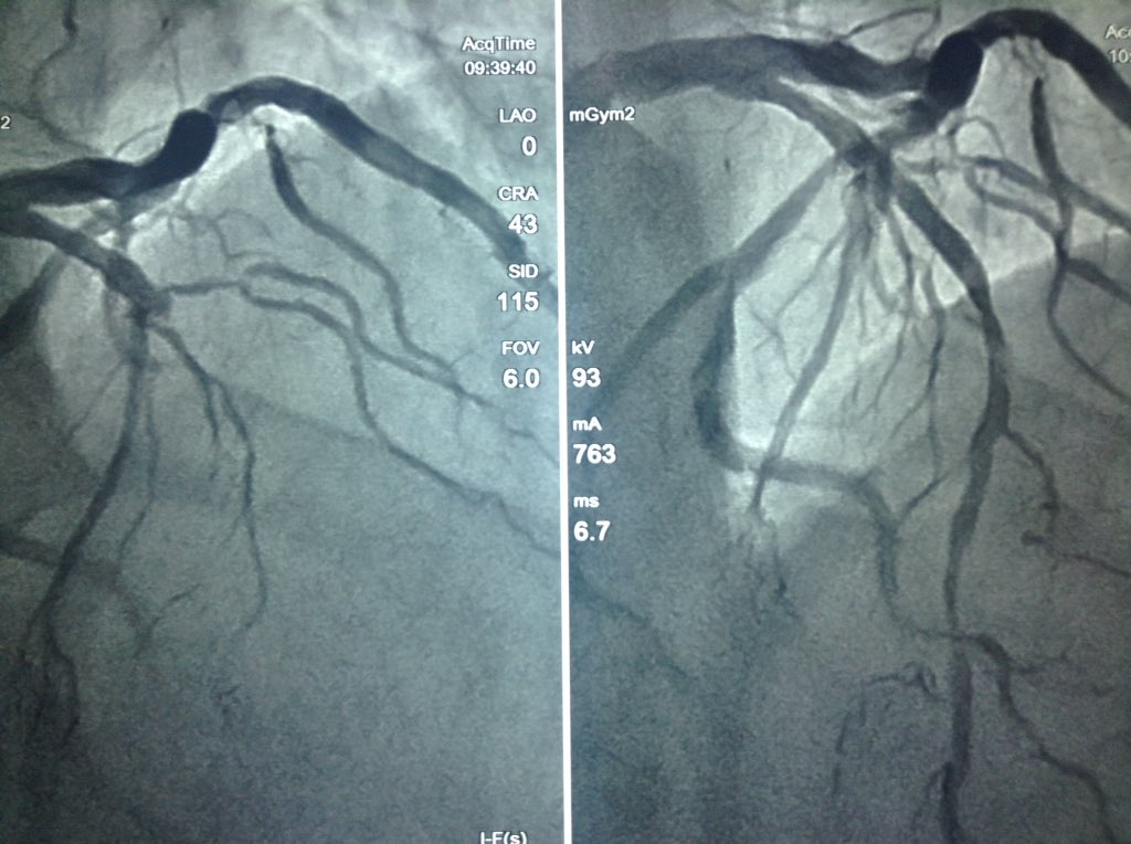 dr_zapataruiz's tweet photo. Good day! LAD CTO & ostial LAD ISR, right #RadialFirst approach both JL 6 Fr #Pilot150, provisional stent https://t.co/qmxvfDVuwL