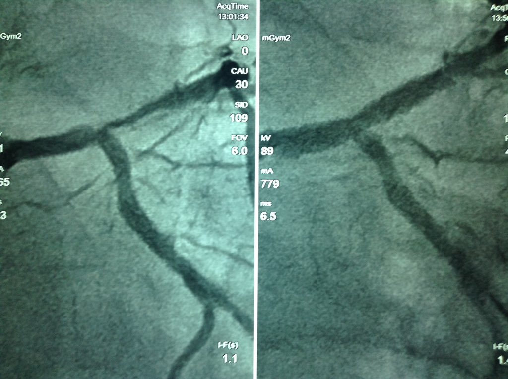 dr_zapataruiz's tweet photo. Good day! LAD CTO & ostial LAD ISR, right #RadialFirst approach both JL 6 Fr #Pilot150, provisional stent https://t.co/qmxvfDVuwL