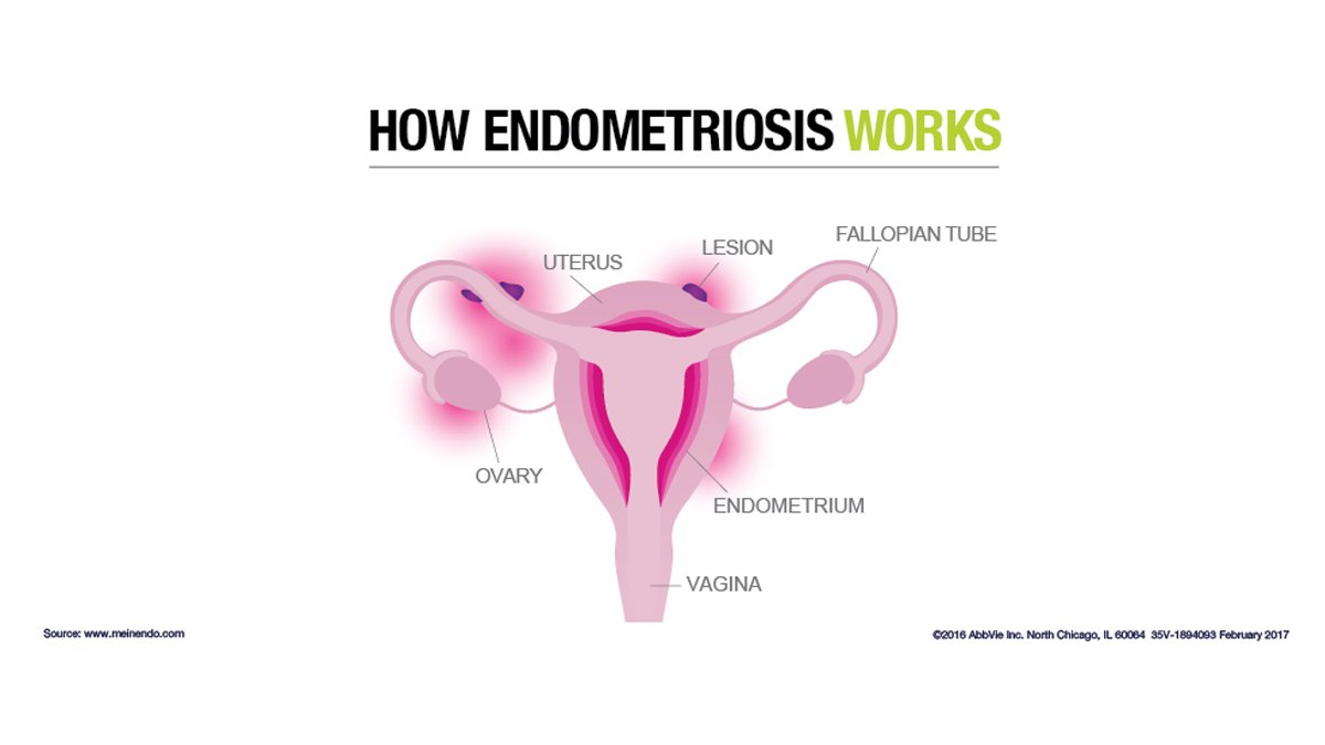 abbvie's tweet image. At #BlogHer17 hundreds of women have learned about #endometriosis. For even more info visit: MeinEndo.com (US)