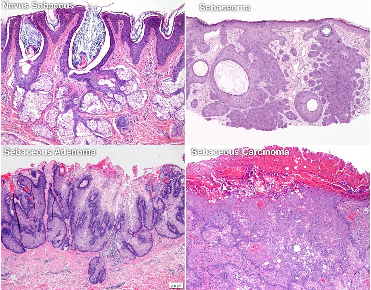 WebPathology (@webpathology) on Twitter photo Sebaceous neoplasms updated; 80 images; webpathology.com/case.asp?case=…; #dermpath #pathologists <a href="/Pathologists/">CAPathologists</a> <a href="/JMGardnerMD/">Jerad Gardner, MD</a> @phmckee1948 Sebaceous neoplasms updated; 80 images; webpathology.com/case.asp?case=…; #dermpath #pathologists <a href="/Pathologists/">CAPathologists</a> <a href="/JMGardnerMD/">Jerad Gardner, MD</a> @phmckee1948