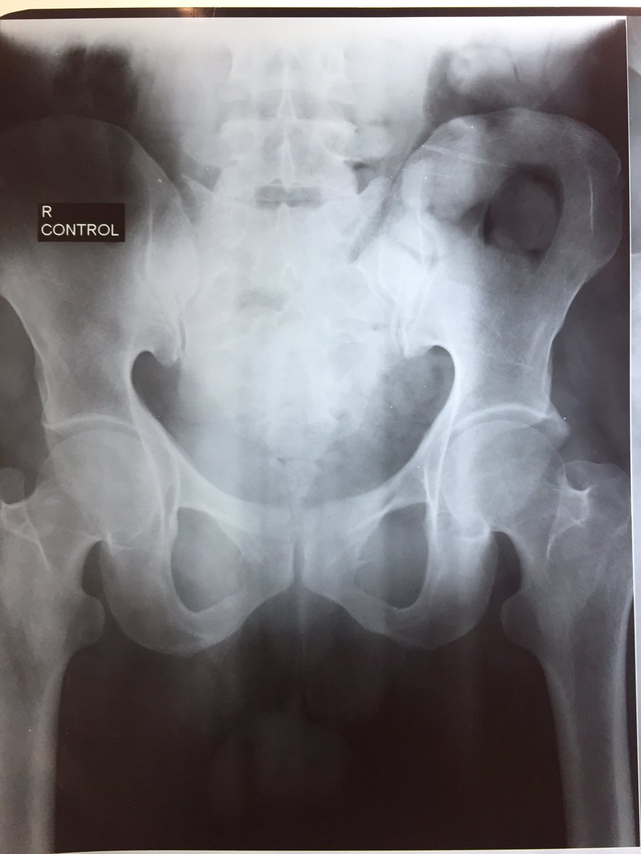 navidmahar's tweet photo. Chronic #LUTS & #ChronicRetention wid impaired RFTs
#MCUG is available while US shows thick walled bladder & PVR=250ml
@eau_yuo @Uroweb https://t.co/79B7jBp67G
