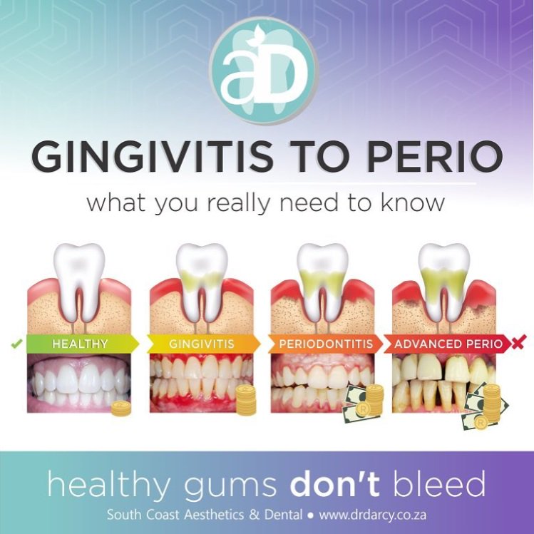 Allsmilescare's tweet photo. Thank you @drdaryldarcy for this great image of the process of health to #gingivitis to #periodontitis #periodontaldisease https://t.co/9WLvijUtYI