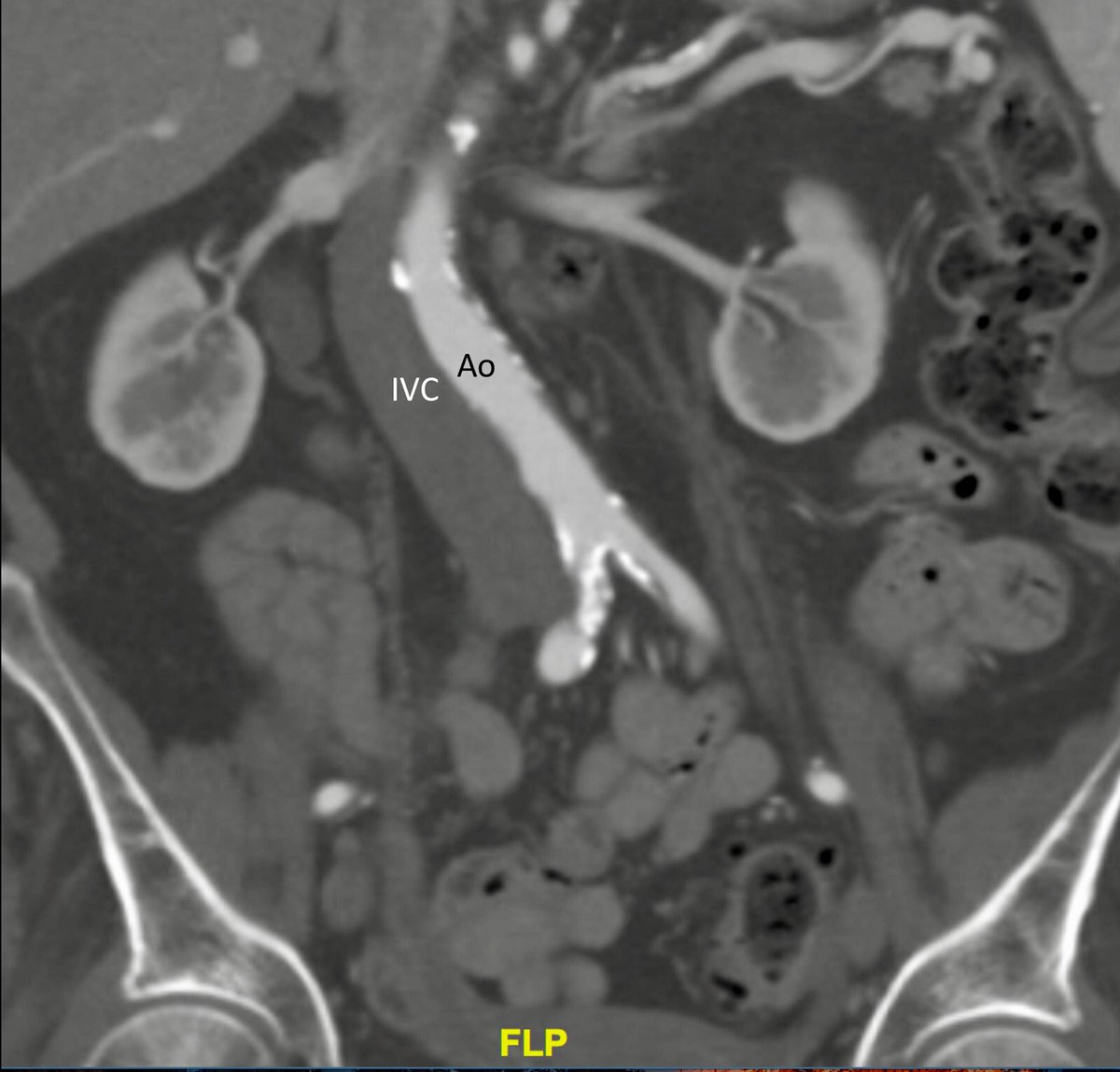 willsuh76's tweet image. 85 yo W with symptomatic #AorticStenosis. Iliacs too small and Ca for TF #TAVR. @AdamGreenbaumMD what do you think about #transcaval ?