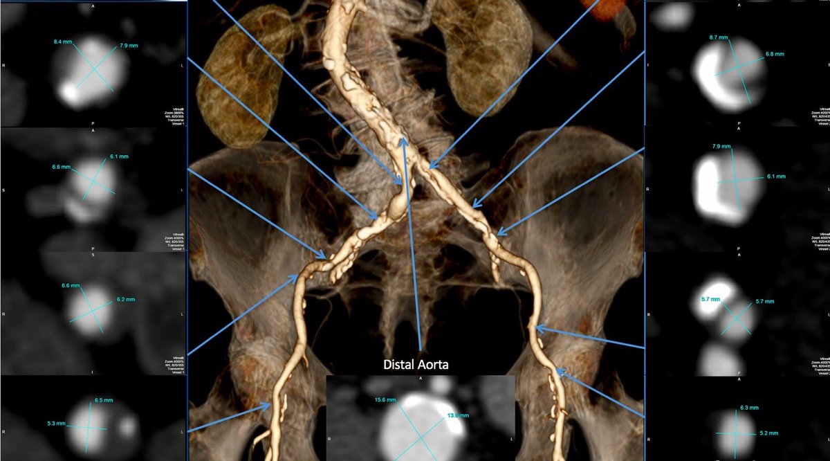 willsuh76's tweet image. 85 yo W with symptomatic #AorticStenosis. Iliacs too small and Ca for TF #TAVR. @AdamGreenbaumMD what do you think about #transcaval ?