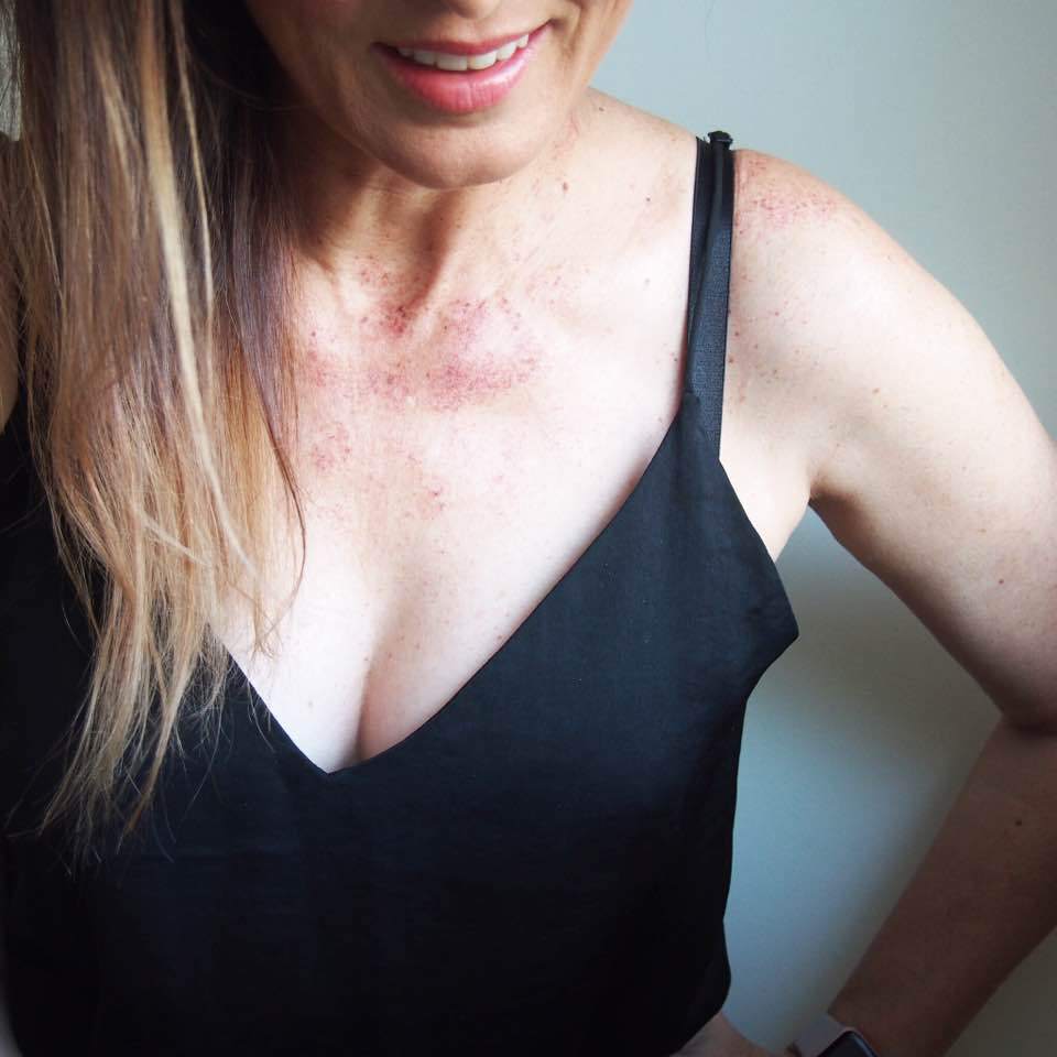 RedcliffeStyle's tweet image. My Laser Pigment Removal Experience redcliffestyle.com/laser-pigment-…