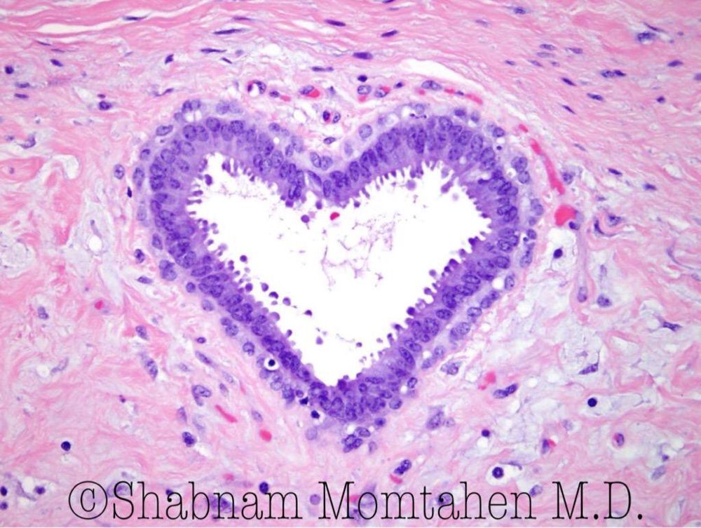 JMGardnerMD's tweet photo. Heart (w apocrine snouts!) in breast fibroadenoma. RT if u❤️ #pathology! #pathArt  Vote top 5 #ASCP40underForty2017: https://t.co/WzktHukz9B https://t.co/2ifzMQsc5v