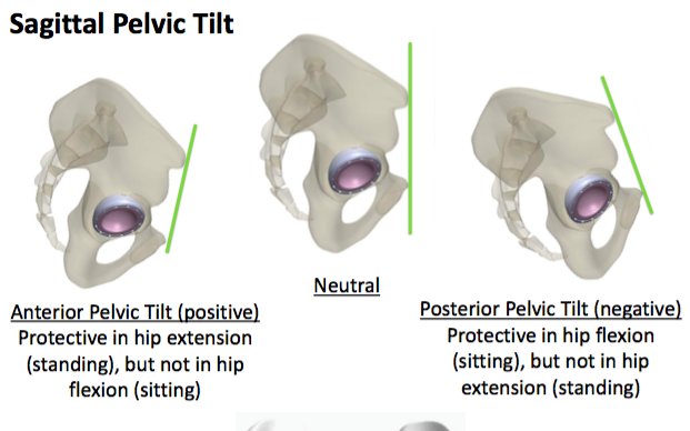 corintechnology's tweet photo. Nearly 1/5 patients have sagittal pelvic rotations that could lead to functional cup malrotation - what can we do? https://t.co/GwEmV8T0zd https://t.co/UblJ02OQ6L