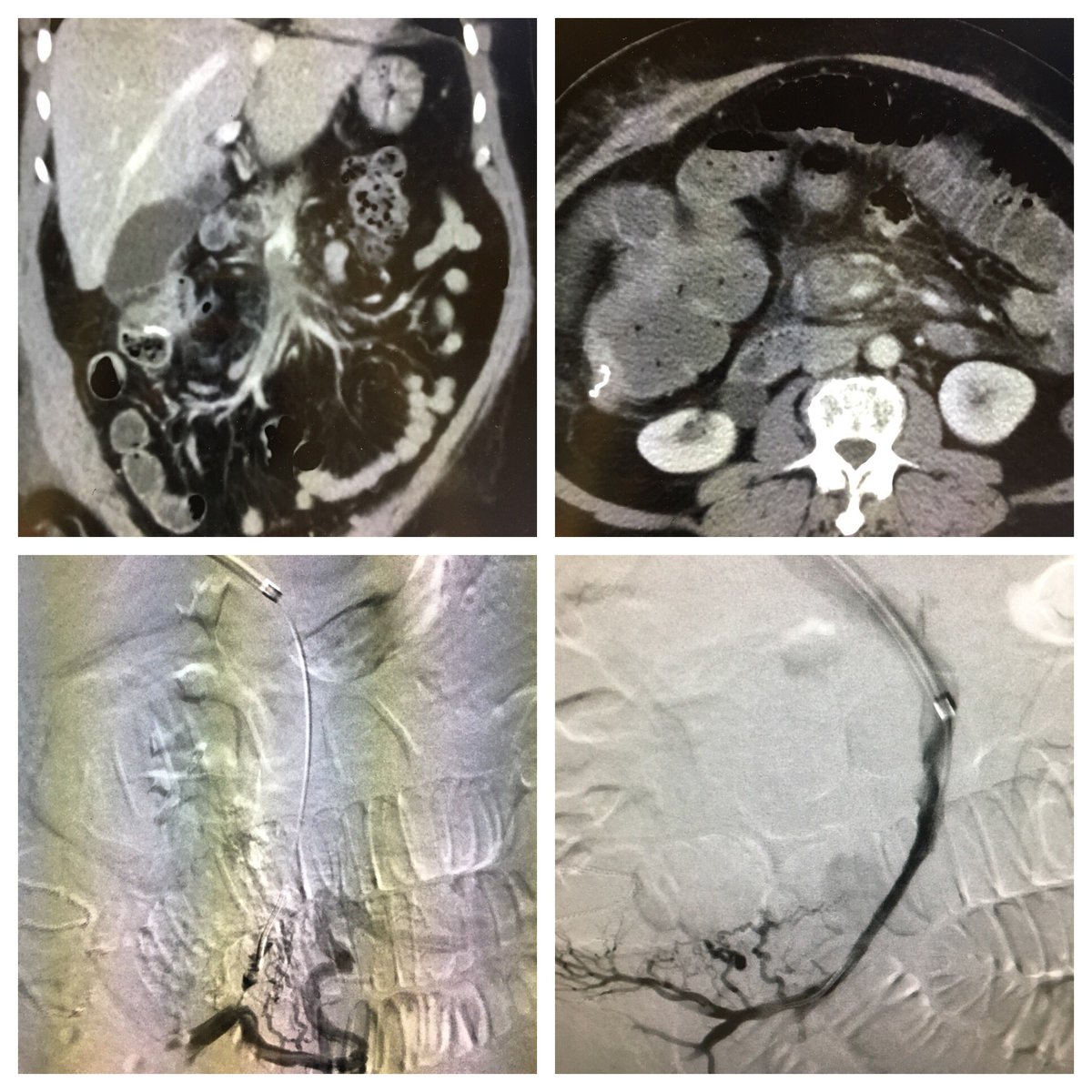 VIRChicago's tweet photo. SMV thrombosis failed AC, scary looking bowel on CT. Transhep PV access, penumbra ,plasty, and lysis. Symptoms resolved. Nice @Saukalaka ! https://t.co/OzGNAO33Fd