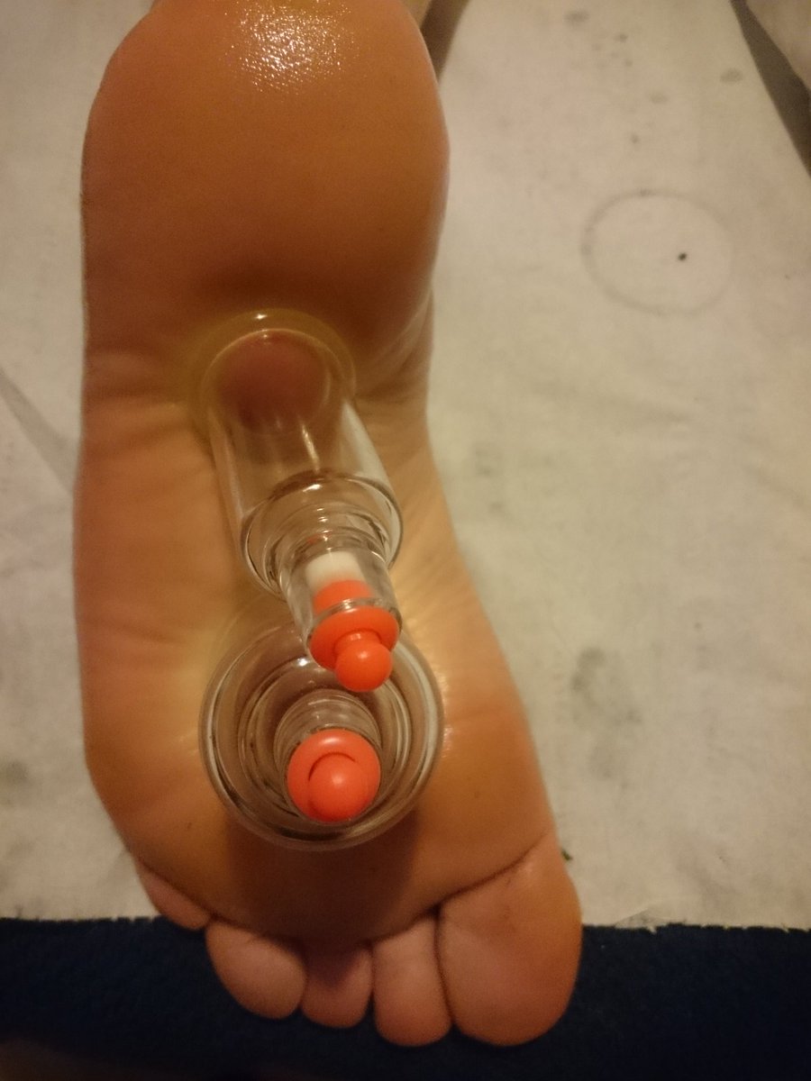 energytherapie1's tweet photo. Treatment a few weeks back for a tight plantar facsiitis #http://energytherapies.co.uk/tcm-and-cupping quite a common injury these days https://t.co/XMGupz6Z6p
