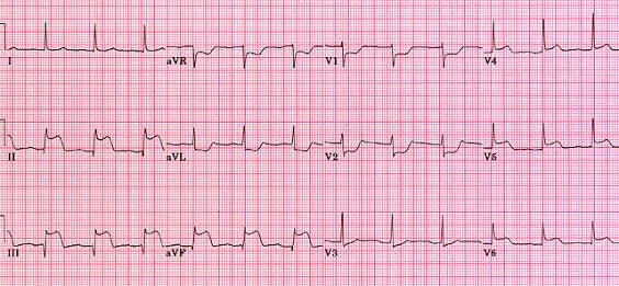 *D2-3-aVF-V5-6 derivasyonlarında ST elevasyonu
*D1-aVL-V1-3 derivasyonlarında ST depresyonu
=İnferioposteriolateral Myokard İnfarktüsü