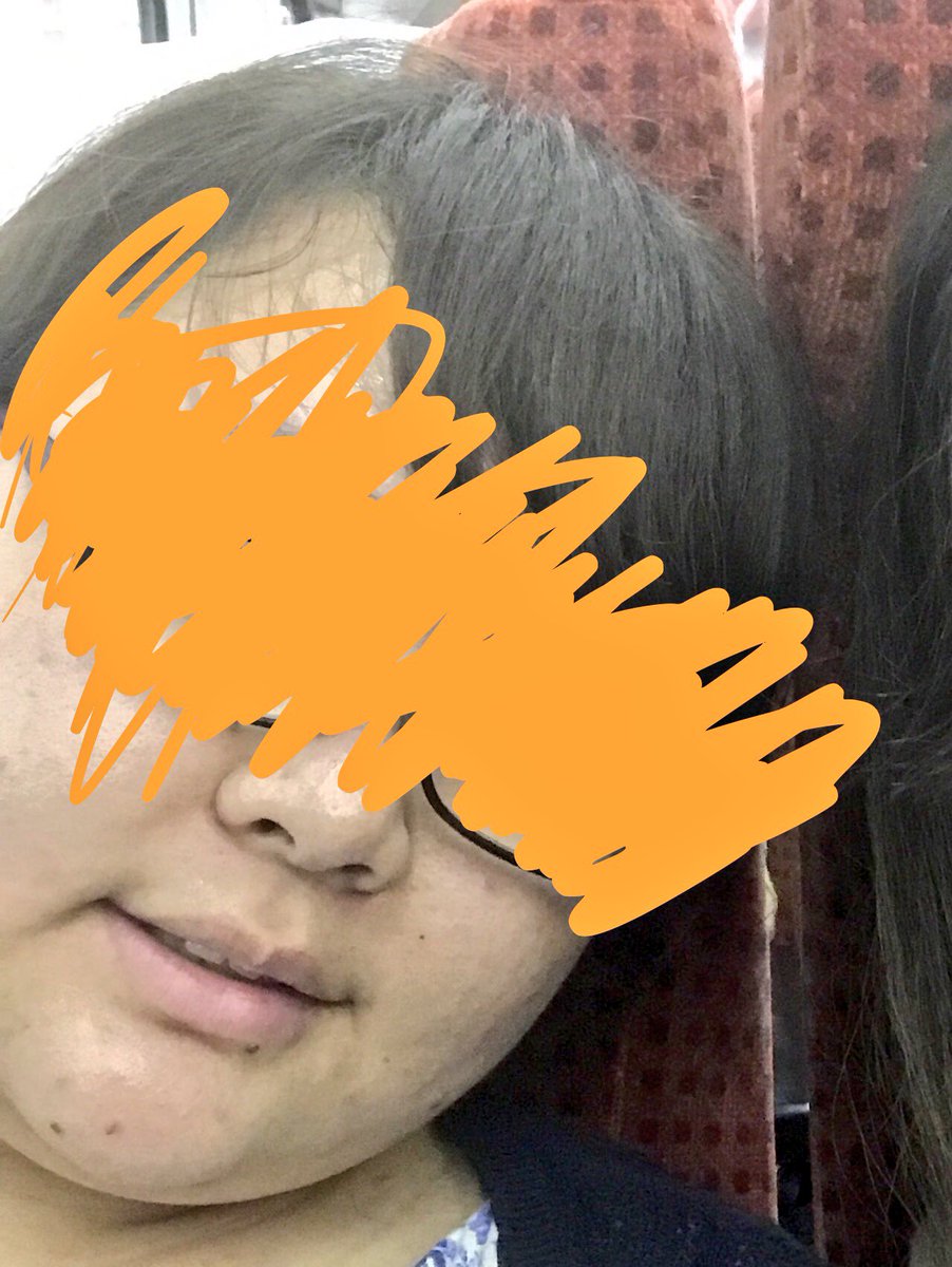 knitte_'s tweet photo. ドライヘッド×フェイシャルに感動したのでビフォーアフターをあげて寝ます 見よこの顎先を 
←ビフォー(日曜) アフター(さっき)→ https://t.co/eUocmIYvlX