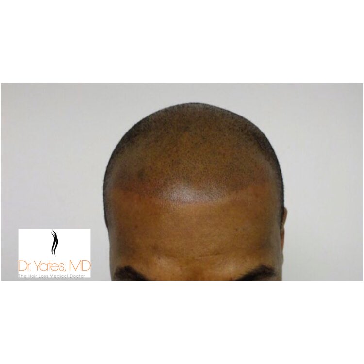 yateshairandmed's tweet image. Follicular Micro Pigmentation, Aldo known as Scalp Micro Pigmentation is a great technique that when done correctly yields great results.