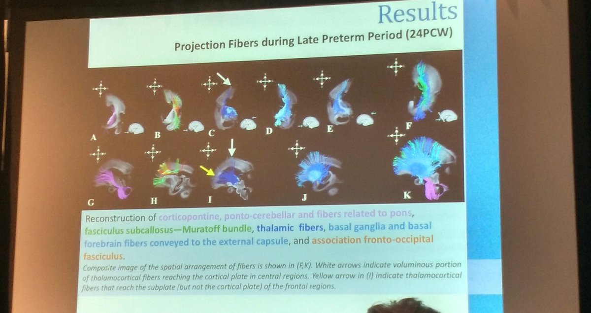 sophieadler's tweet image. Lana vasung showing amazing work on fetal development of fibre tracts #OHBM2017 #corticaldevelopment