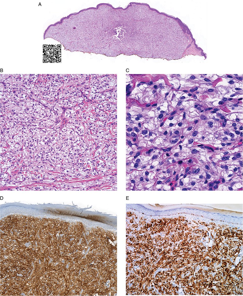 Rosalynn Nazarian MD (@rosnazarianmd) on Twitter photo Primary cutaneous PEComa (perivascular epithelioid cell tumor) CD10+ HMB45+<a href="/JCutaneousPath/">J Cutan Pathol</a> <a href="/JMGardnerMD/">Jerad Gardner, MD</a> #dermpath onlinelibrary.wiley.com/doi/10.1111/cu… Primary cutaneous PEComa (perivascular epithelioid cell tumor) CD10+ HMB45+<a href="/JCutaneousPath/">J Cutan Pathol</a> <a href="/JMGardnerMD/">Jerad Gardner, MD</a> #dermpath onlinelibrary.wiley.com/doi/10.1111/cu…