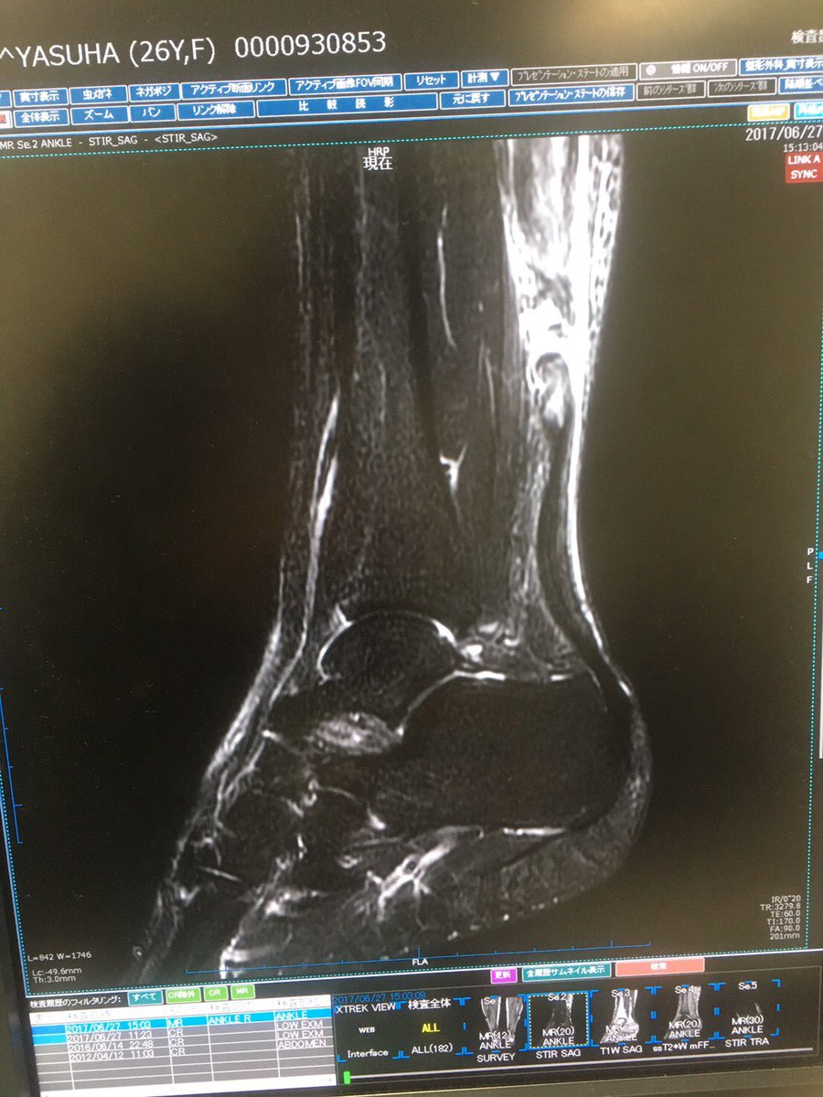 Yasuha On Twitter Mriで撮らないとわからない ようなところでアキレス腱断裂ってもはや神技www木曜の時点でわかってたら撮影会も作品撮りも参加させてもらえなかったから結果として良かったです 手術したいって言ったけど 場所が悪過ぎて保存療法になってしまい