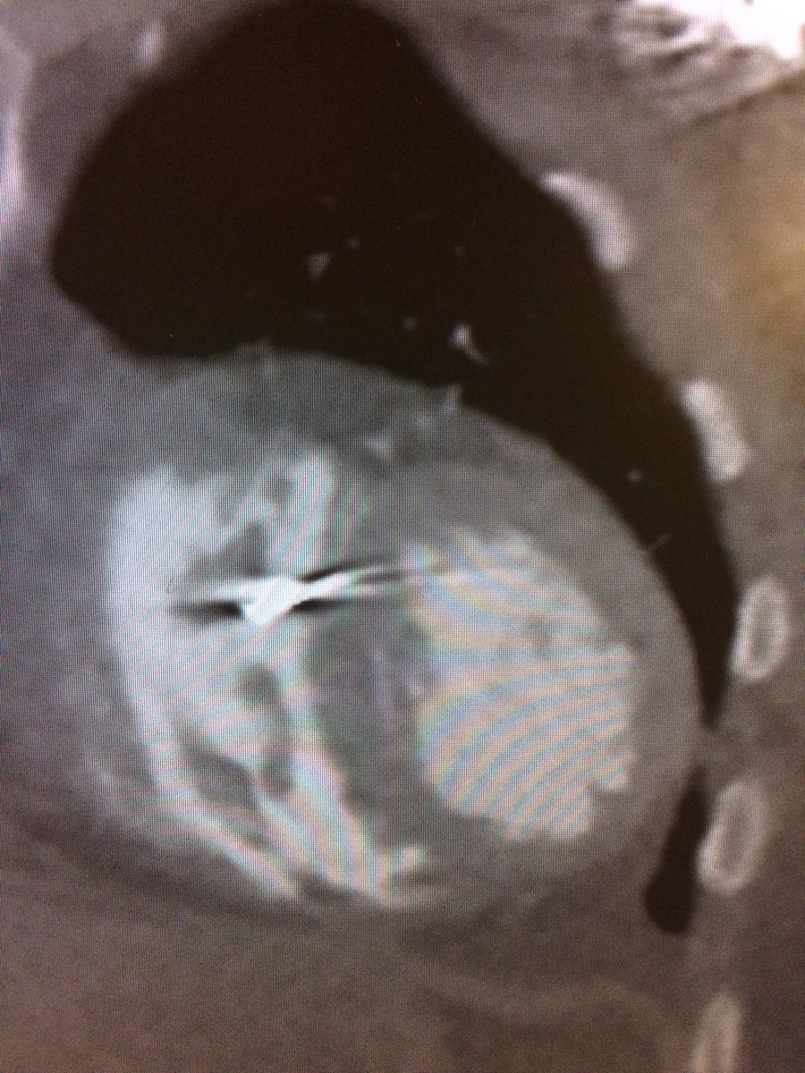 Septal pacing: The "Diagram" and reality. <a href="/narrowQRS/">JMC</a>