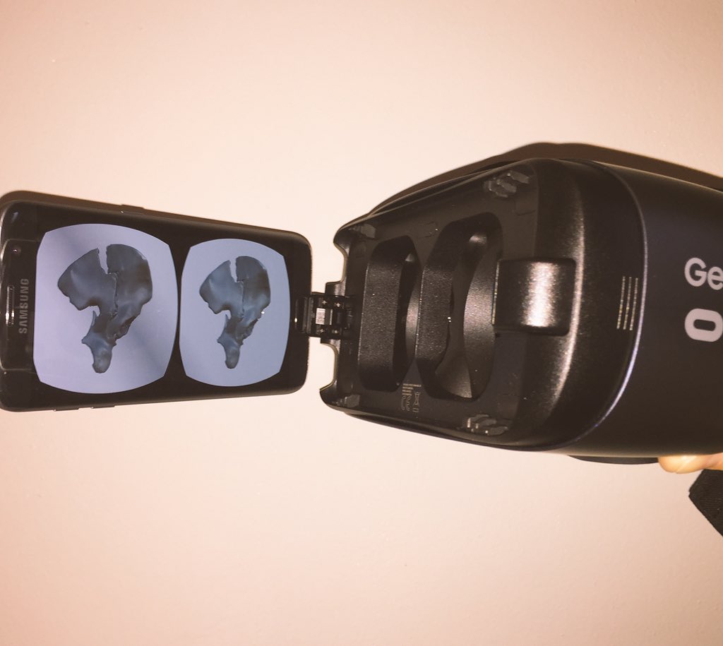Lars Brouwers, MD, PhD, MSc (@brouwers_3d) on Twitter photo Preliminary results show the benefit of #VR in classifying acetabular fractures #3Dsurgery <a href="/ETZnl/">ETZ</a> <a href="/traumatilburg/">traumachirtilburg</a> @3DLabNijmegen <a href="/Til_Surg/">Chirurgen Tilburg</a> Preliminary results show the benefit of #VR in classifying acetabular fractures #3Dsurgery <a href="/ETZnl/">ETZ</a> <a href="/traumatilburg/">traumachirtilburg</a> @3DLabNijmegen <a href="/Til_Surg/">Chirurgen Tilburg</a>