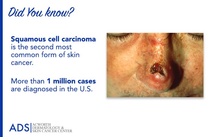 Squamous Cell Carcinoma (SCC) is the second most common form of #skincancer. More than 1 million cases are diagnosed in the U.S. each year.