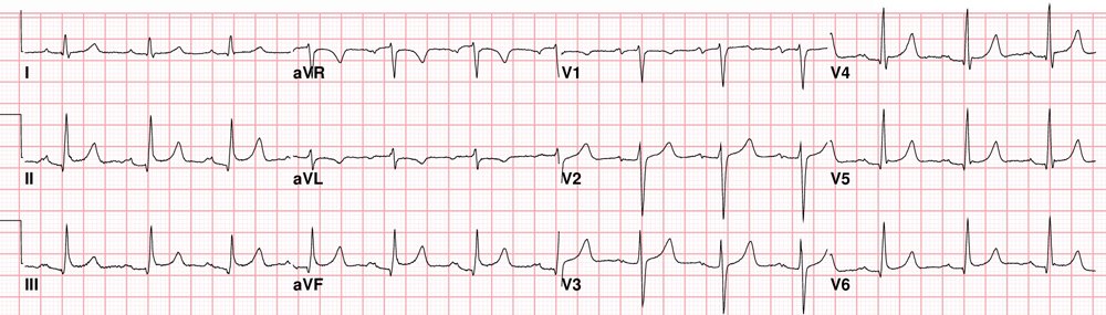 EM_RESUS's tweet photo. 67-year-old lady with sudden onset chest pain. STEMI or just Pericarditis vs Early Repolarization? https://t.co/7lEkXv1ijz