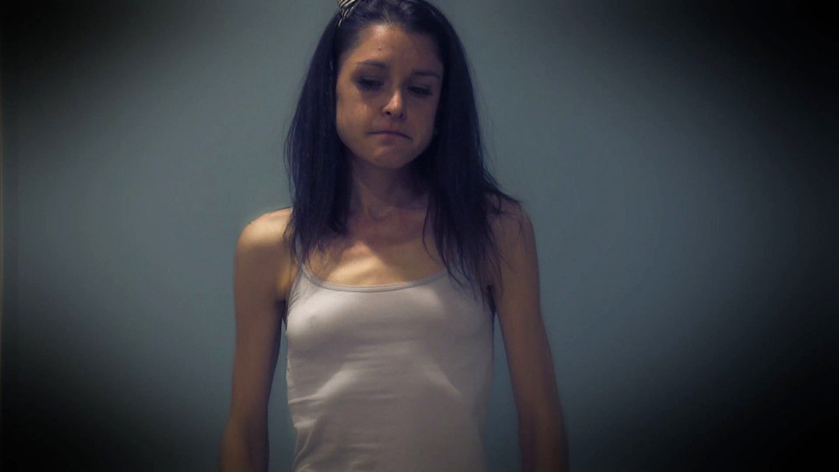 #Anoreksiya nasıl teşhis edilir? ... #AnoreksiTedavisi #AnoreksiTeşhisi #KadınHastalıkları #YemeBozukluğu #Zayıflık goo.gl/87XJyi