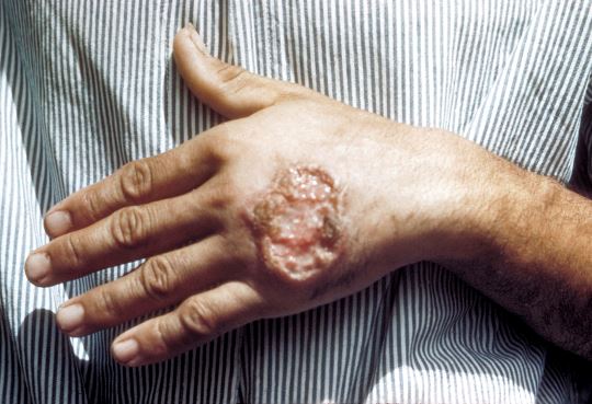 Read about what <a href="/FIND/">find</a> &amp; other organizations are doing about #leishmaniasis in <a href="/WHOs/">whos</a> Global Observatory on Health R&amp;D bit.ly/2tovjMc