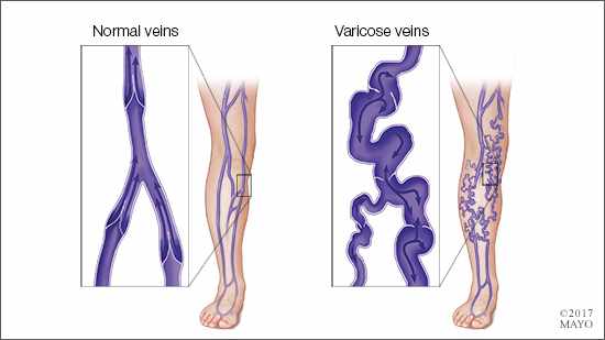 MayoClinic's tweet photo. #VaricoseVeins, healthy bones, #AlzheimersDisease end-of-life needs, and more in Consumer #HealthTips. https://t.co/H9YZiGg83n https://t.co/WyQHUKrAVn