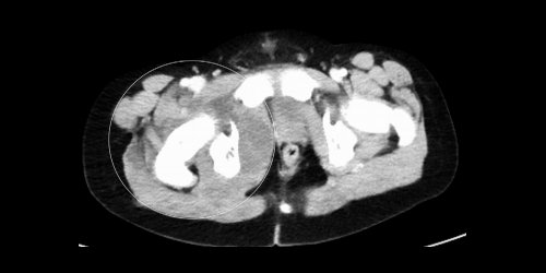 jbjs's tweet image. New Team Approach Article in #JBJSReviews¬—How to evaluate and treat #pyomyositis in kids bit.ly/2t0UdhD