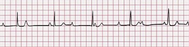 *Düzenli ritim
*Sabit olmayan PR intervali
*Kendi arasında düzenli p dalgaları
*Bradikardik hız

=3. Derece AV blok(Tam kalp bloğu)