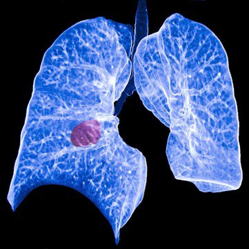 TCAG2M's tweet photo. How #PrecisionMedicine is directing #LungCancer therapy on the @UAhealthnet Healthy Dose Blog from @ValSchaibley https://t.co/W4KCivVWeM https://t.co/FNxm0Rv8GC