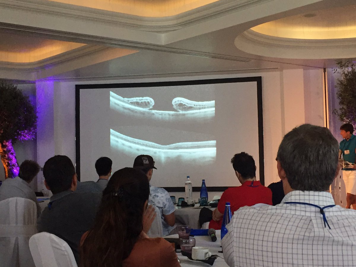 NJRetinaDoc's tweet photo. Technique for closing large macular holes by Carl Claes - subretinal injection of BSS to loosen retina from underlying RPE #clubvit2017 https://t.co/3ILbLOwwg4