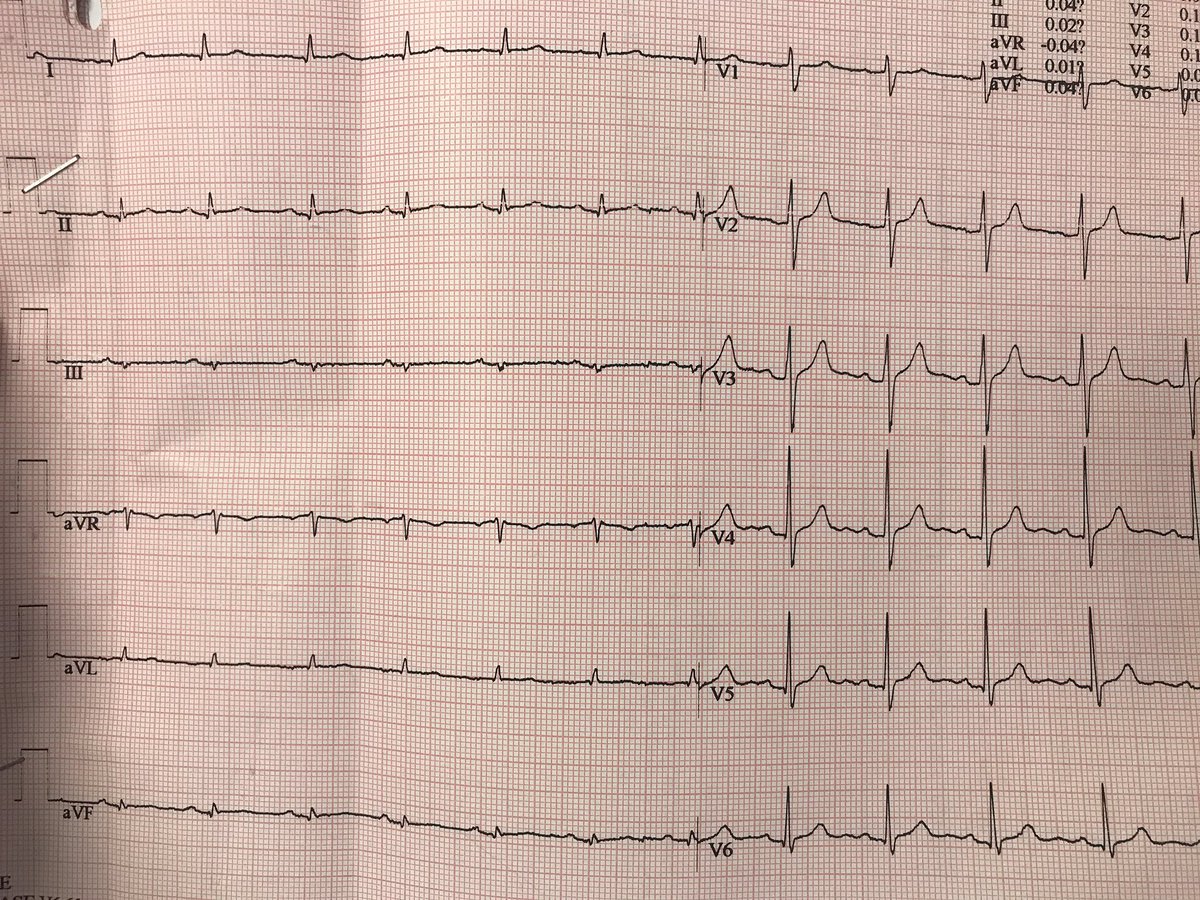 atypicalflutter's tweet image. Male 39 Yo anxious pt w/Palpit. grade I mitral valve prolapse.RMN2016min subepi LE IV post med. septum. Stress test... VT or Not VT?